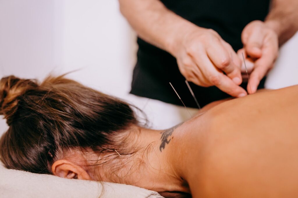 woman receiving acupuncture on back